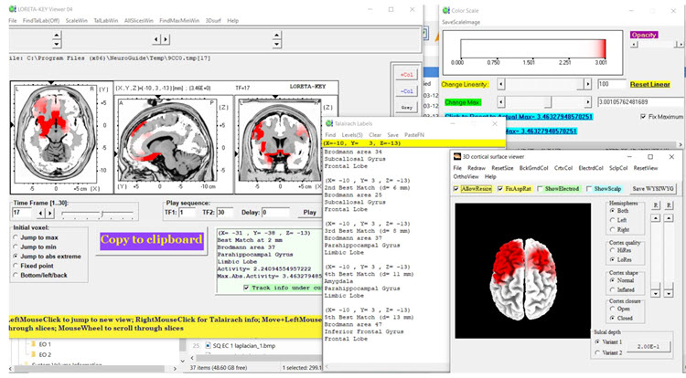 Figure 5 - Baseline eyes-closed z-score LORETA analysis for 17 Hz showing medial frontotemporal localization